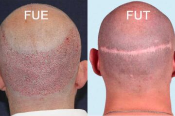 FUE vs. FUT Hair Transplant