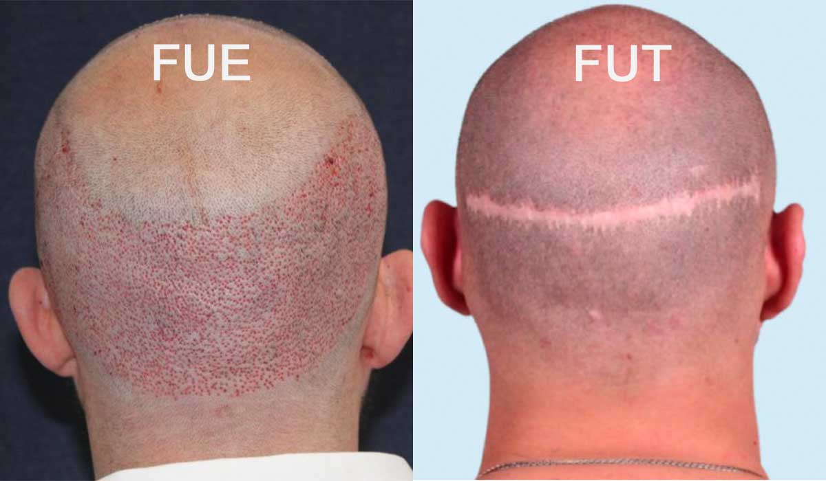 FUE vs. FUT Hair Transplant