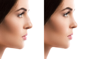 Rhinoplasty