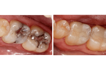 Amalgam Fillings