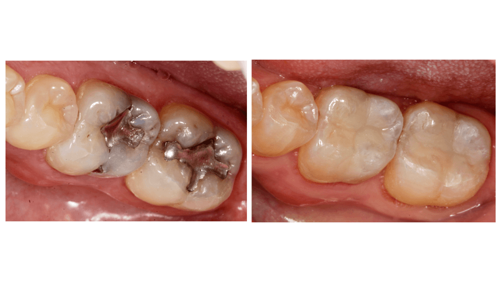 Amalgam Fillings